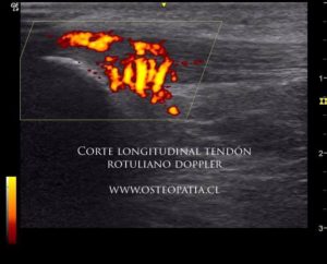 tendinosis