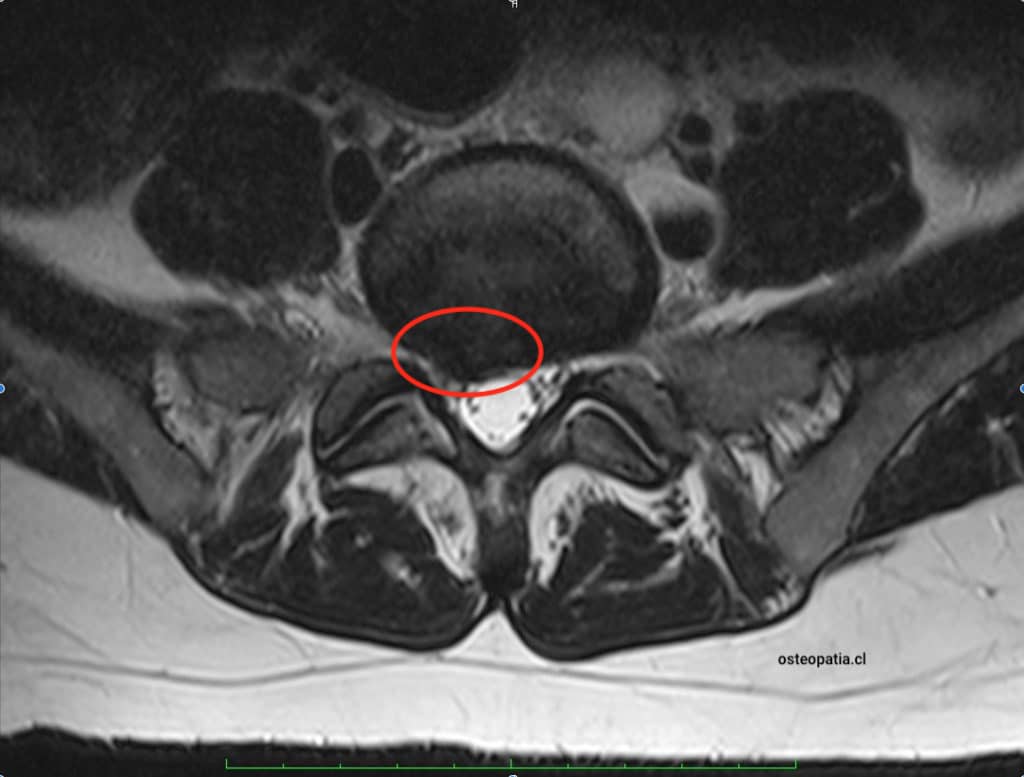 Hernia-discal-osteopatia.jpg