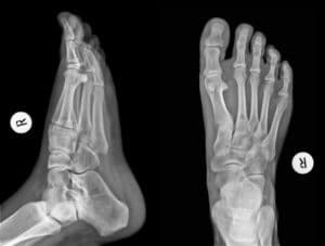 causas fascitis plantar osteopata