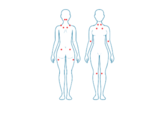 fibromialgia osteopatia