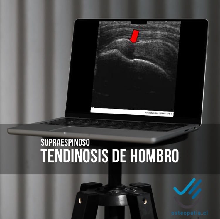 Hombro humano con indicadores gráficos mostrando la zona del tendón afectada por tendinosis
